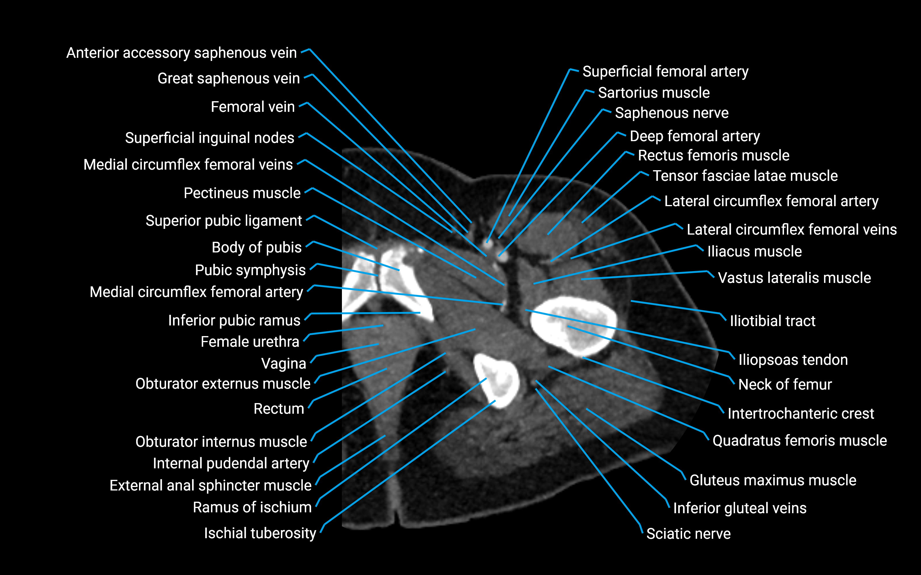 CT Hip axial cross sectional anatomy labelled image 14 (2).png